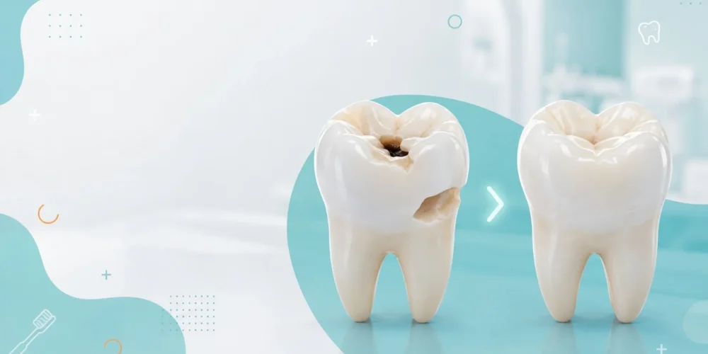 Resina-Dental-Clínica-dental-Bokali-Xalapa